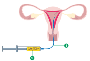 Artifitial insemination