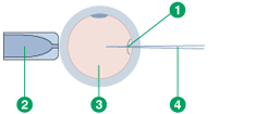 ICSI procedure schematic