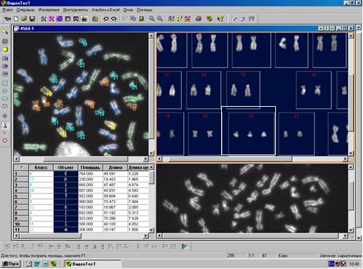 Computer-aided analysis of the karyotype of a fetus with a Down syndrome, performed in our clinic