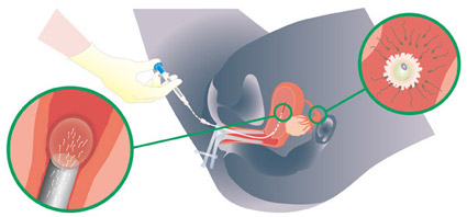 Intrauterine insemination (IUI)