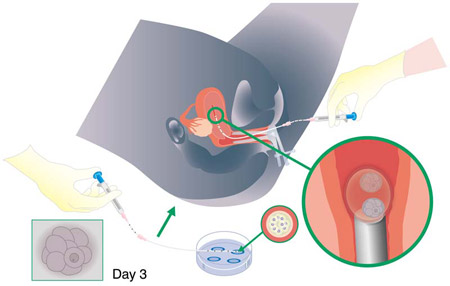 Embryotransfer