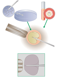 ICSI